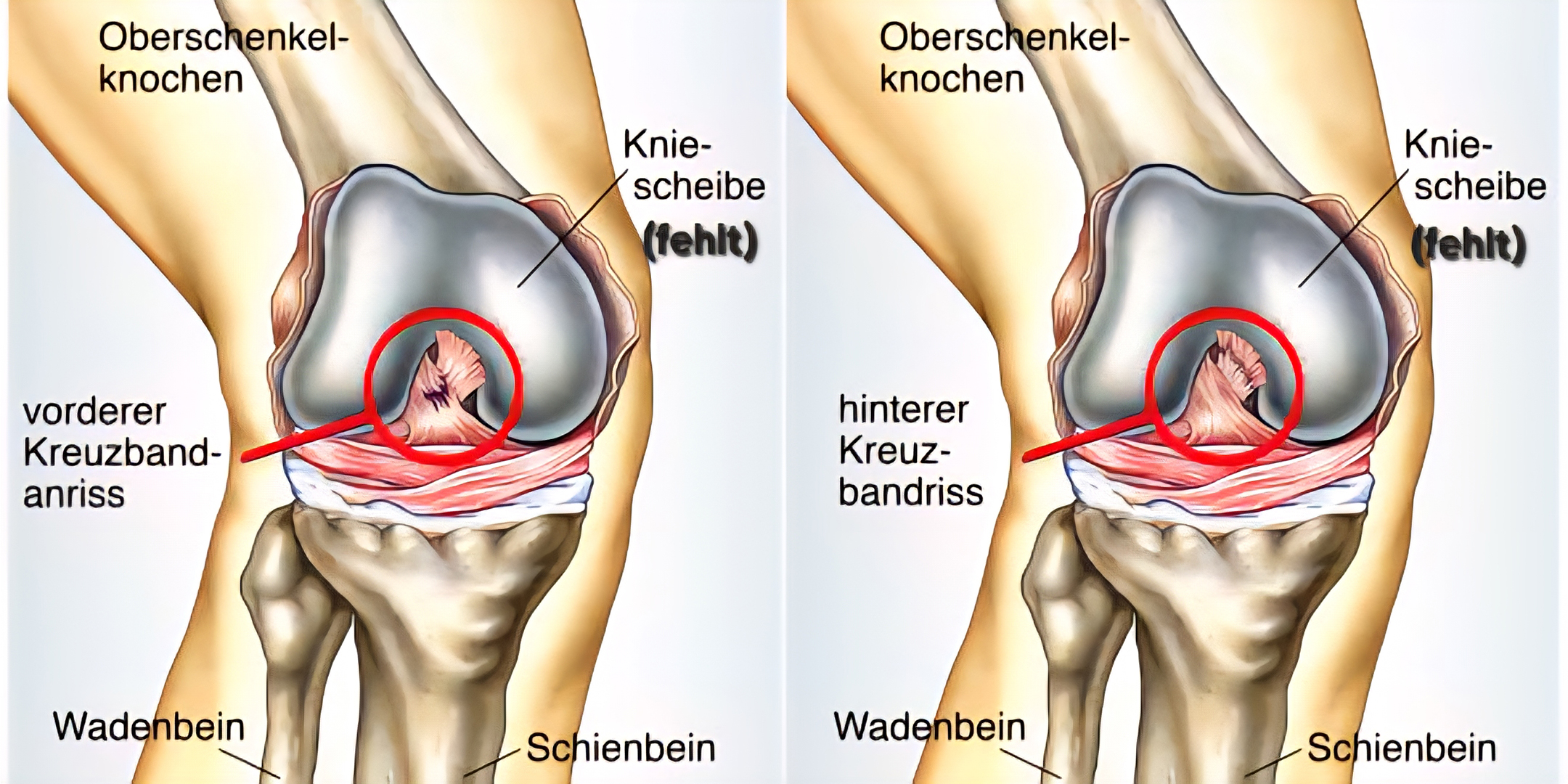 St. Bernhard Hospital Brake erweitert orthopädisches Spektrum: Jetzt auch Operationen am hinteren Kreuzband möglich